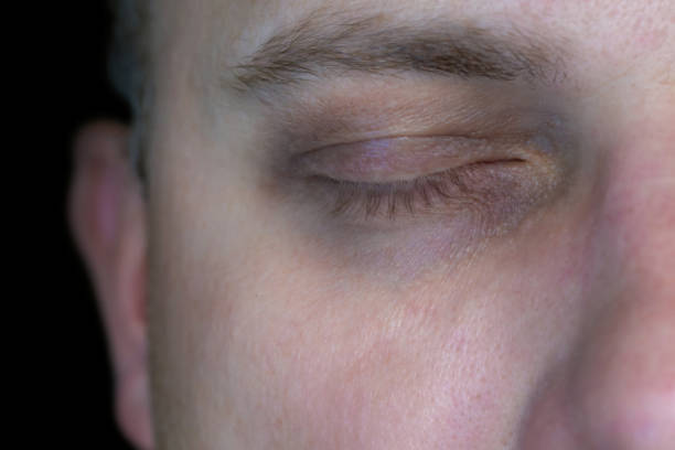 Tired skin and dark circles