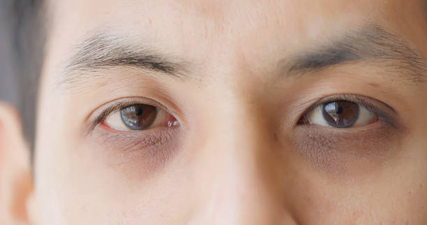 Puffy eyes and dull skin
